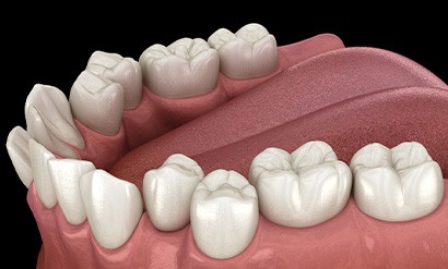 Illustration of crowded teeth