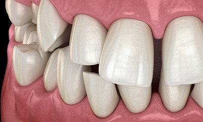 Illustration of gapped teeth