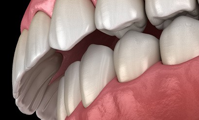 Illustration of an overbite