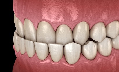 Illustration of an underbite