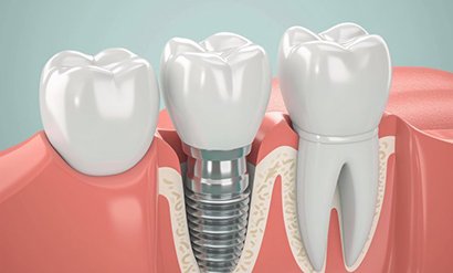 a 3D depiction of a dental implant in the jawbone