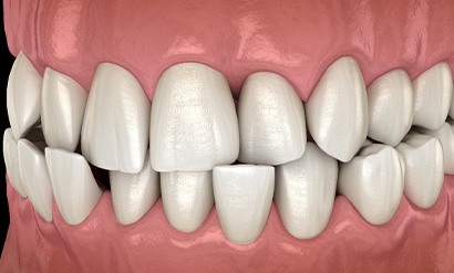 Illustration of a crossbite