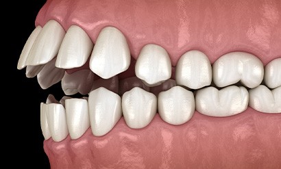 Illustration of an open bite
