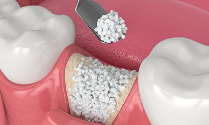 Illustration of bone grafting being performed in lower arch