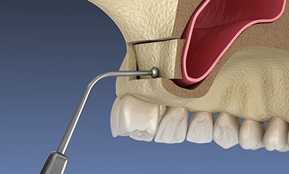 Illustration of grafting material being placed for sinus lift