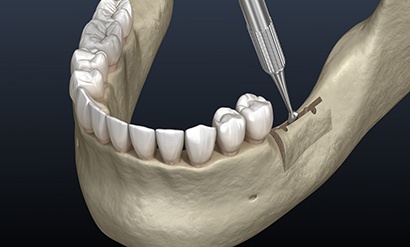 Illustration of ridge expansion being performed at the back of the lower jaw