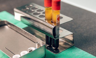 Two vials of platelet-rich plasma for PRP treatment