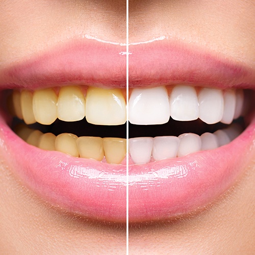 smile before and after whitening