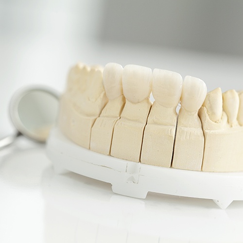 dental bridge mockup