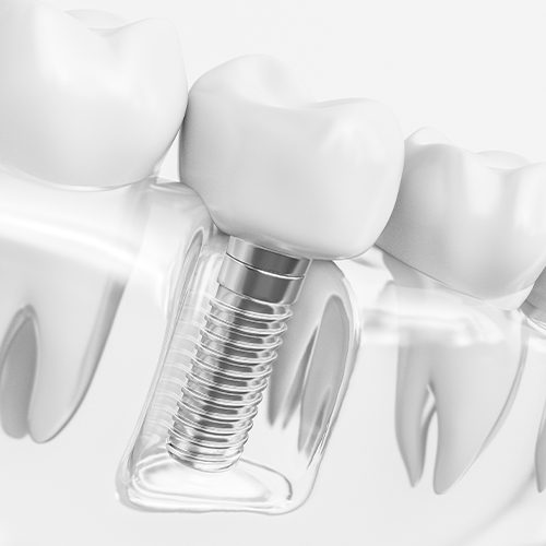 implant in clear mockup smile