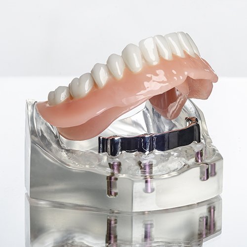 implant supported dentures