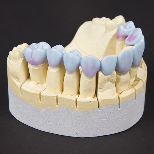 denture creation process