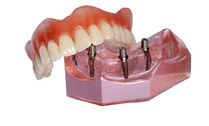 Model of implant dentures