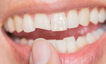 chipped tooth