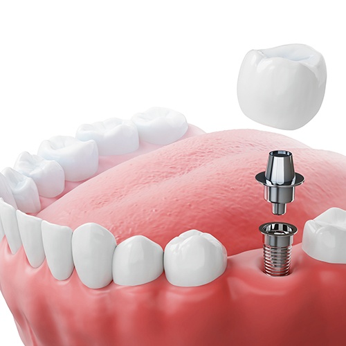 CGI rendering of a dental implant in a lower arch with white background