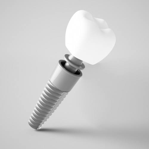 a closeup of a dental implant post