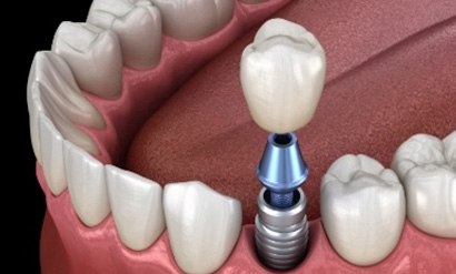 a dental implant being used to replace a single tooth
