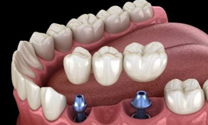 : a graphic render of a mouth with three missing teeth