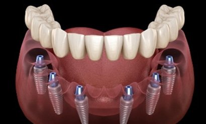 a graphic render of a mouth with multiple missing teeth