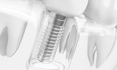 a closeup of a dental implant post after placement