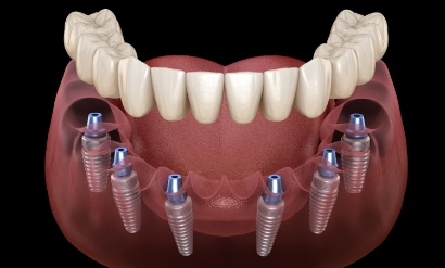 implants for whole mouth