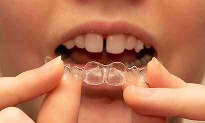 Closeup of a teen with diastema removing Invisalign from upper arch