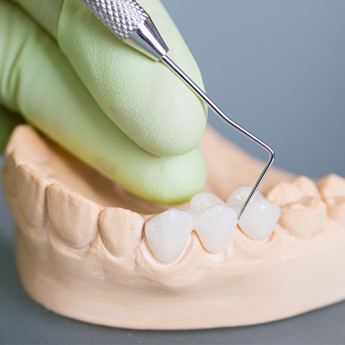 dental bridge example