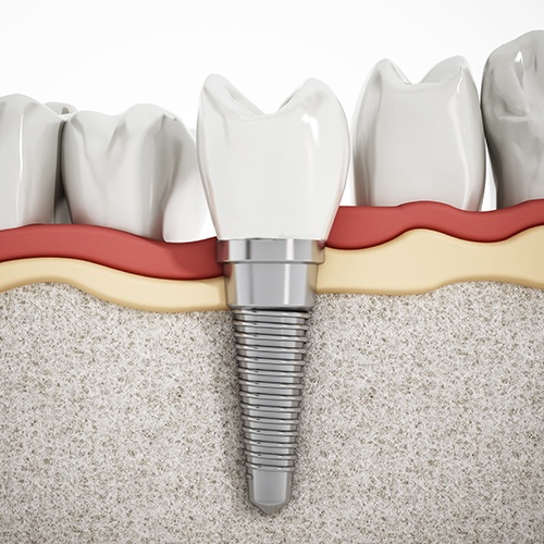 illustration of dental implant