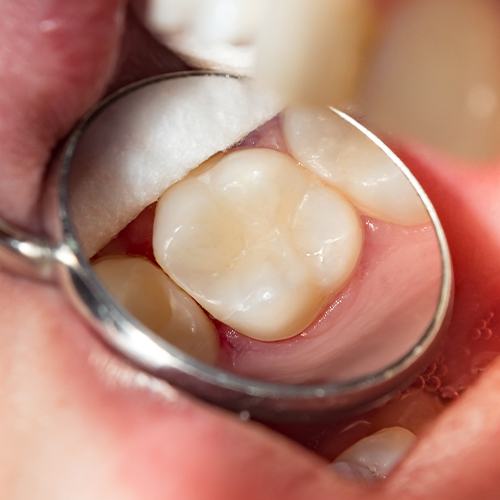 tooth with tooth colored fillings