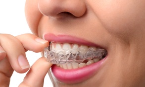 An up-close look at a woman taking out her top Invisalign aligner 