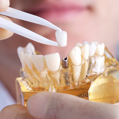 placing single tooth implant