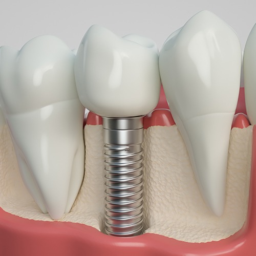 implant in bone mockup