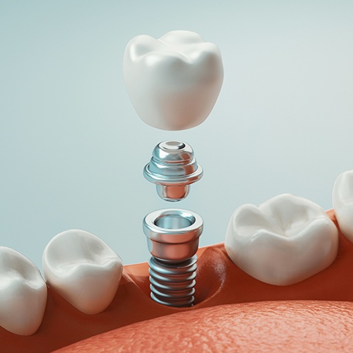 three parts of implant