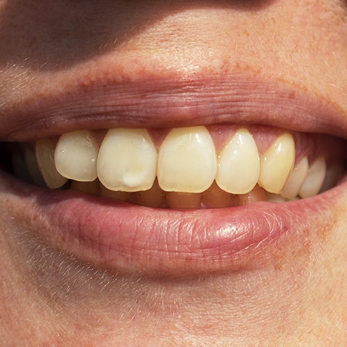 discolored teeth