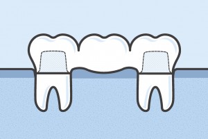 A crown and bridge in Falls City is a great way to replace several missing teeth in a row. 