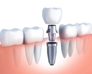 diagram of dental implants in Falls City