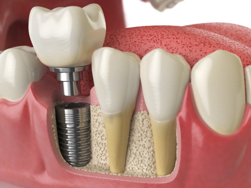 Illustration of dental implants in Falls City